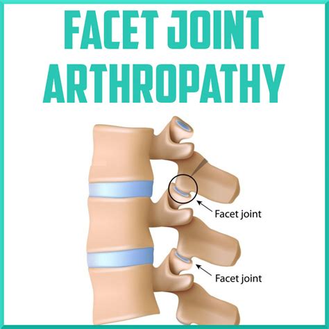 Facet Joint Arthropathy - Sports Medicine Review