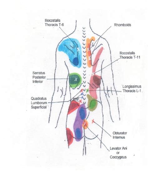 Hip Trigger Point Chart