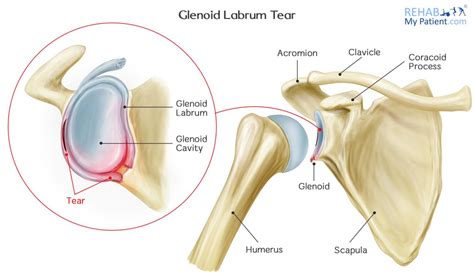 Glenoid Labrum Tear | Rehab My Patient