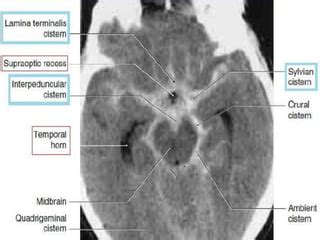 Cisterns of brain and its contents along with its classification and ...