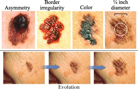 All About the ABCDs of Skin Cancer | St Louis Dermatologists