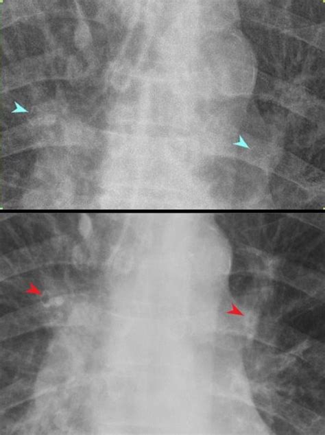 Peribronchial Cuffing | Lungs