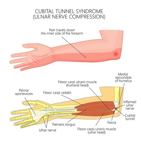 Causes of Elbow or Arm Pain