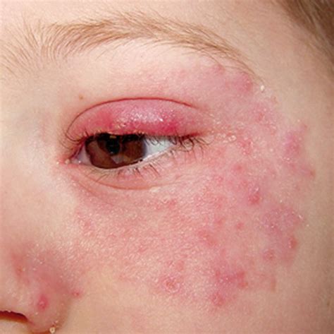 rash around eyes pictures - pictures, photos