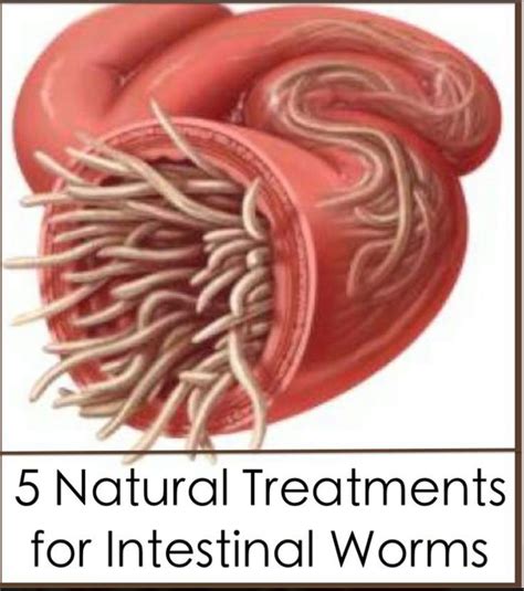 5 Natural Treatments for Intestinal Worms | Detox | Pinterest | Natural ...