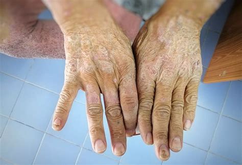 What is Scleroderma? | Columbus Arthritis Center