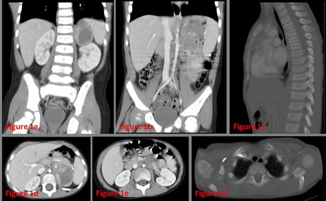 Exported NEUROBLASTOMA OF THE ADRENAL GLAND