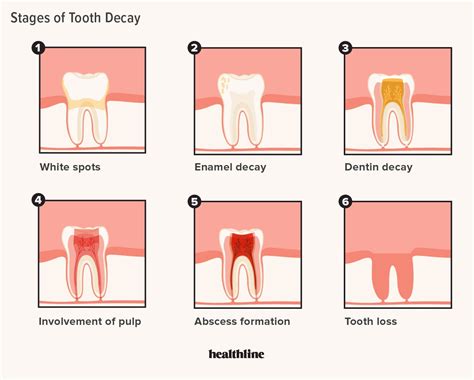 Dental Caries Dental Caries Medical Diagnosis And Therapy