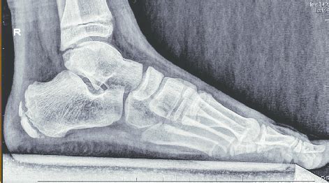 X-ray of sclerosis in the calcaneal apophysis with fragmentation ...