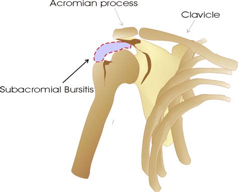 Subacromial bursitis: Causes, Treatment & Exercises : Physiosunit