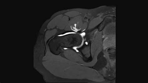 Labral tear and CAM impingement of the hip - complete MRI examination ...