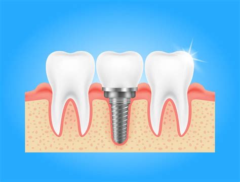 Tooth Implant Types