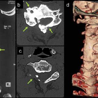 (PDF) Osteoid Osteoma and Osteoblastoma of the Cervical Spine: The ...