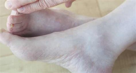 Gangrene and Diabetes: Understanding the Link