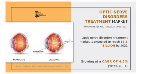 Optic Nerve Disorders Treatment Market Projected to Reach $5.3 billion ...