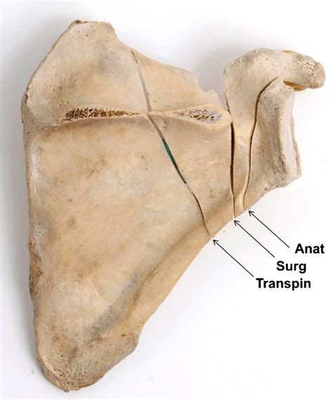 Scapular Fracture