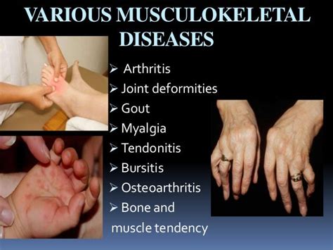 Austin Journal of Musculoskeletal Disorders