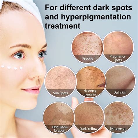 Dark Spot Remover for Face | Hyperpigmentation & Melasma Treatment ...