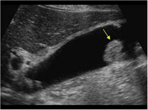 Abdomen and retroperitoneum | 1.2 Gallbladder and bile ducts : Case 1.2 ...