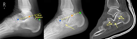 Calcaneal Fracture - Radiology at St. Vincent's University Hospital