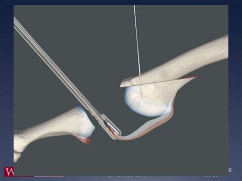 Dorsal Anatomic Plantar Plate Repair