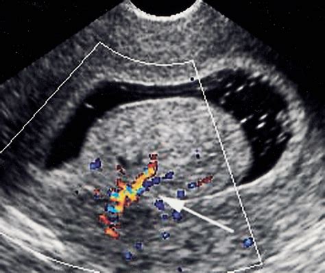 Sonohysterographic Findings of Endometrial and Subendometrial ...