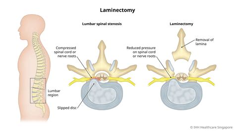 Laminectomy | Gleneagles Hospital