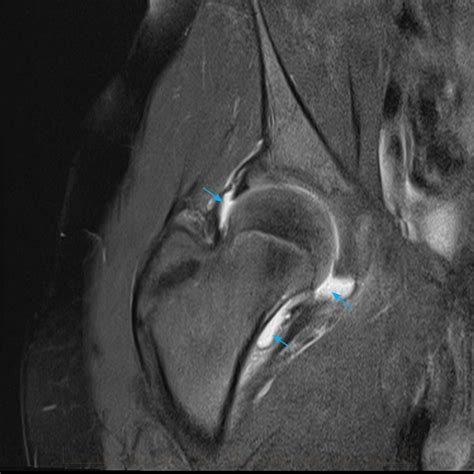 MRI Hip - Paediatic MRI Series - GP Referred