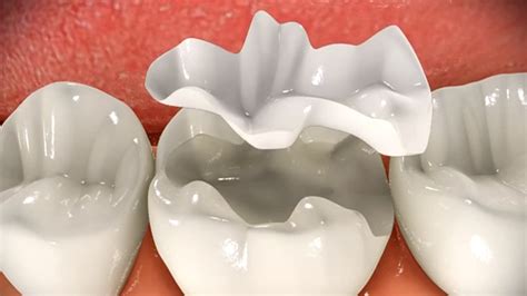 Ceramic Inlays and Onlays | DMS Dentistry