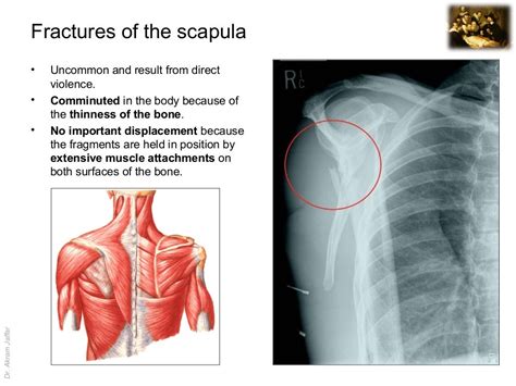 Scapola Frattura Trattamento - Frattura