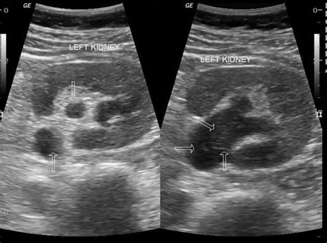 Pyonephrosis | Radiology Case | Radiopaedia.org | Medical ultrasound ...