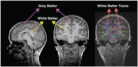 White Matter Counts: Brain Connections Help Us Do 2 + 2 · Articles ...