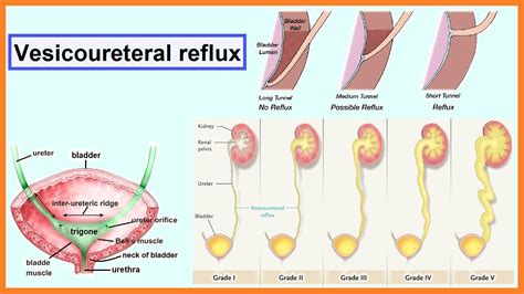 vesicoureteral reflux - YouTube