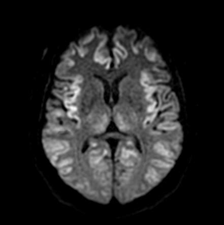 Hepatic Encephalopathy Mri