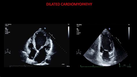 Echocardiography in dilated cardiomyopathy - YouTube