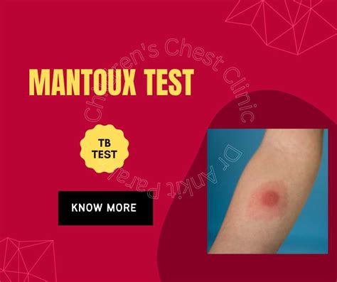 Understanding a Positive Mantoux Test - Info Dong