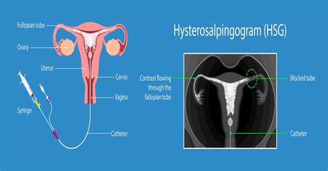 HSG Test for Infertility: Procedure, Advantages and Side effects