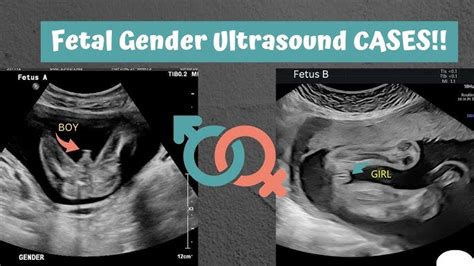 20 Week Ultrasound | informacionpublica.svet.gob.gt