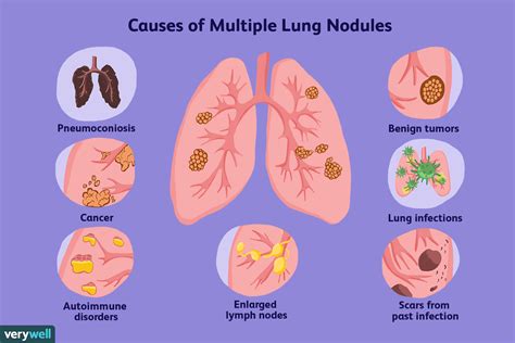 Multiple Lung Nodules: Overview and More | Lunges, Diagnosis, Lung ...