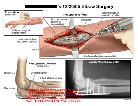 AMICUS Illustration of amicus,surgery,elbow,fracture,surgical,incision ...