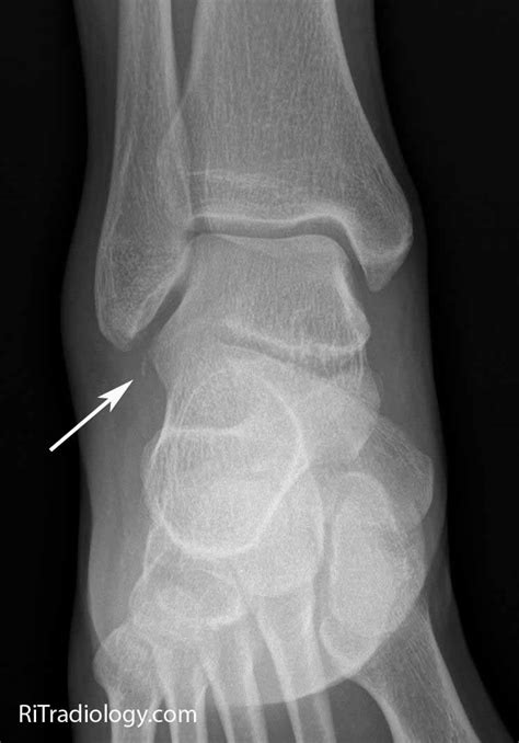 Fracture Of Fibula - Fracture Treatment