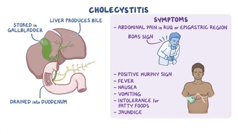 Cholecystitis: Nursing - Osmosis Video Library