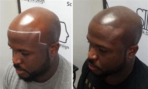 Miami Scalp Micropigmentation | Palm Beach Hair Loss Options