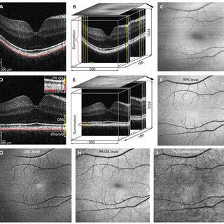 Basal laminar drusen. (A) Colour fundus photograph. (B) Fluorescein ...