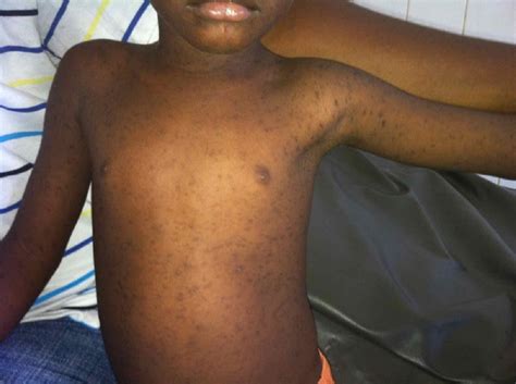 Image of the Week: Erythematous Rash and Fever - Clinical Advisor