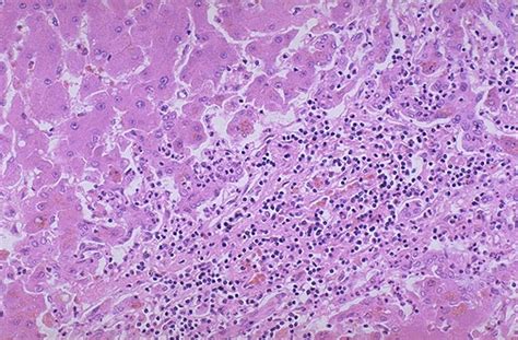 Hepatic Pathology