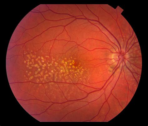 Moran CORE | Wet versus Dry Macular Degenerative Changes