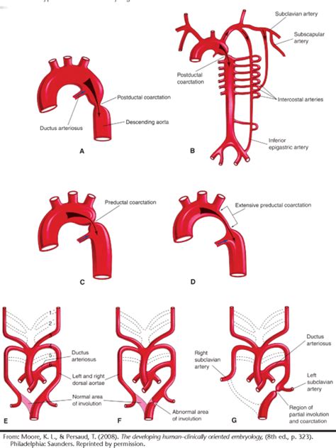 [PDF] Coarctation of the Aorta: A Case Presentation | Semantic Scholar