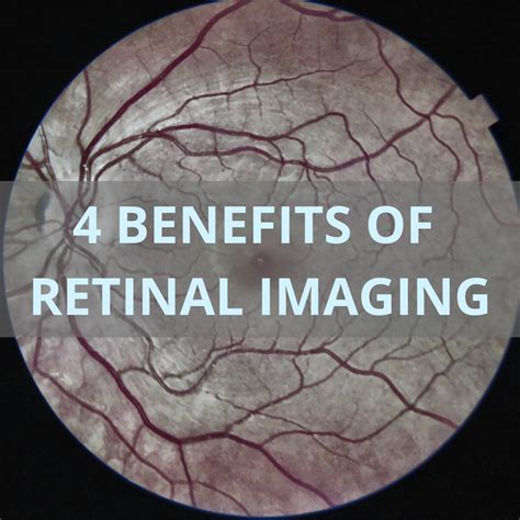 4 Benefits of Retinal Imaging | IRIS