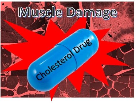 Cholesterol drugs side effects include Cholesterol Drugs Harm Muscles